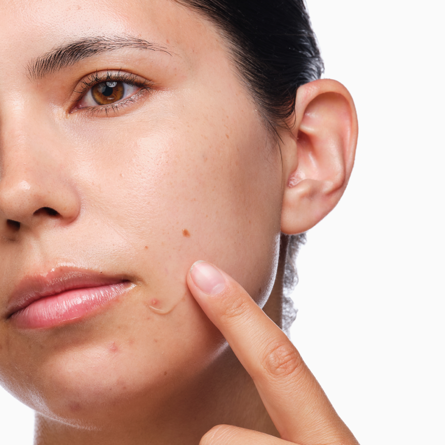 the-acne-set-v1 rdn-the-acne-set-application.png