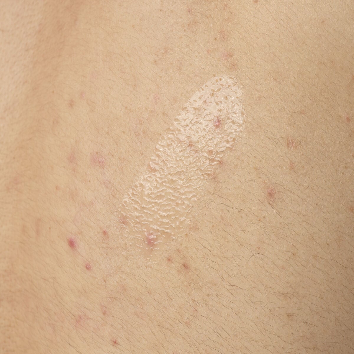 salicylic-acid-0-5-body-serum-t2 ORD-salicylic-acid-05-body-240ml-application.jpg