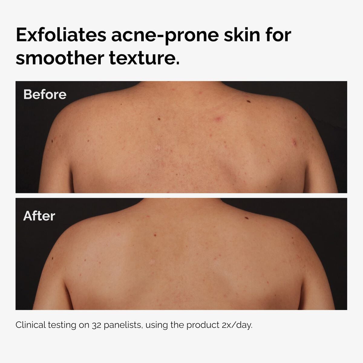 salicylic-acid-0-5-body-serum-t2 ord-salicylic-acid-body-serum-before-after-graphic-NA.jpg